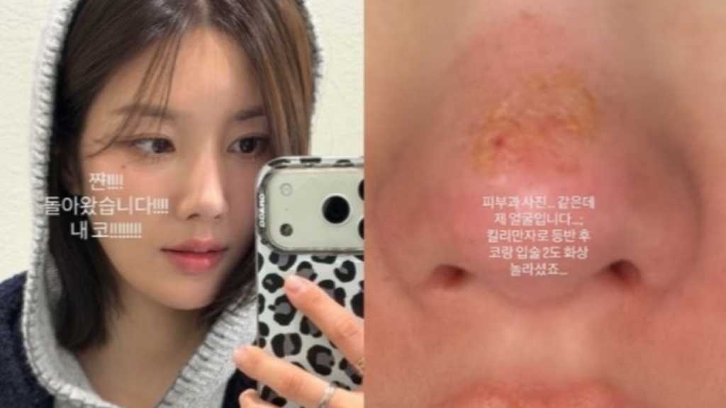 IZ*ONE出身クォン・ウンビ、鼻と唇に火傷…写真と共に報告「キリマンジャロ登山後に」
